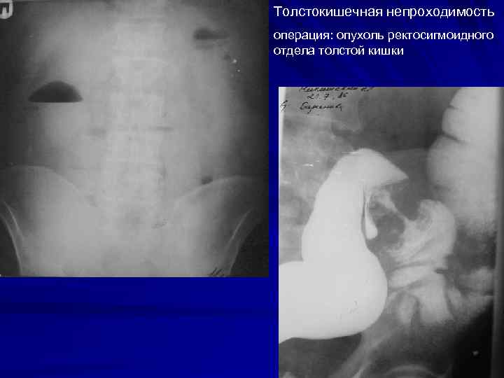 Толстокишечная непроходимость операция: опухоль ректосигмоидного отдела толстой кишки 34 