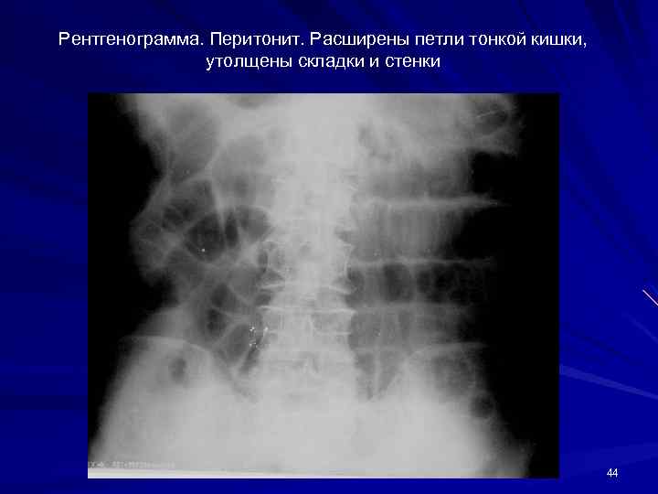 Рентгенограмма. Перитонит. Расширены петли тонкой кишки, утолщены складки и стенки 44 