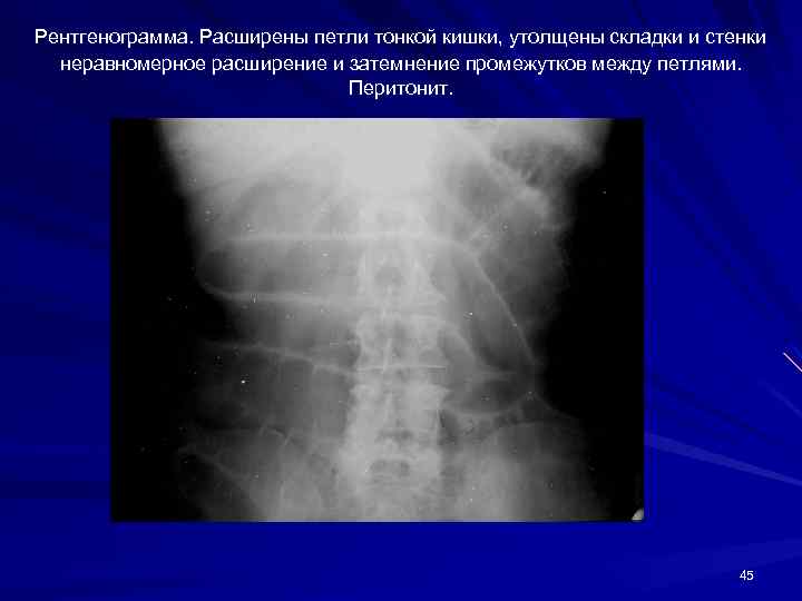 Рентгенограмма. Расширены петли тонкой кишки, утолщены складки и стенки неравномерное расширение и затемнение промежутков