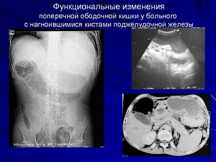  Функциональные изменения поперечной ободочной кишки у больного с нагноившимися кистами поджелудочной железы 64