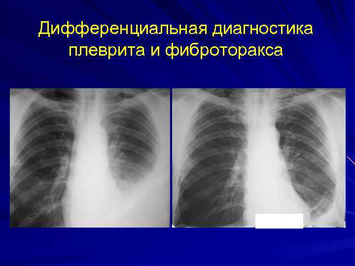 Дифференциальная диагностика плеврита и фиброторакса 