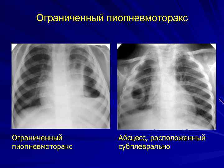 Ограниченный пиопневмоторакс Абсцесс, расположенный субплеврально 