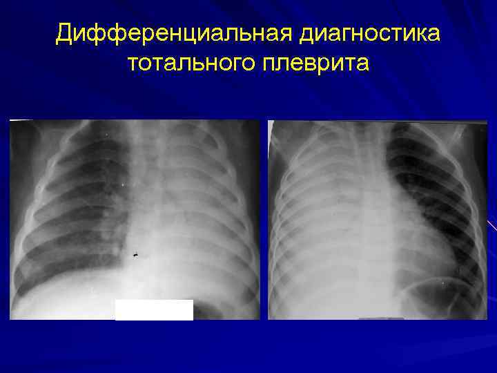 Дифференциальная диагностика тотального плеврита 