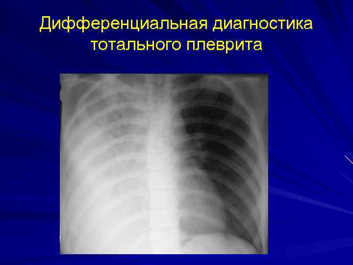 Дифференциальная диагностика тотального плеврита 