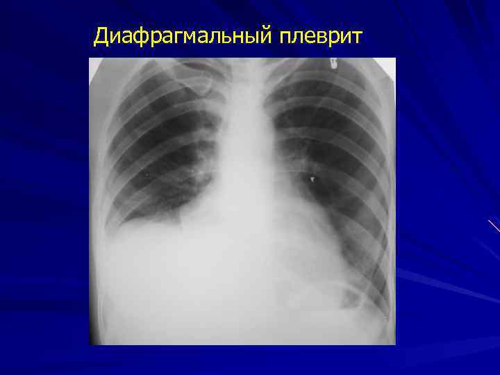 Диафрагмальный плеврит 