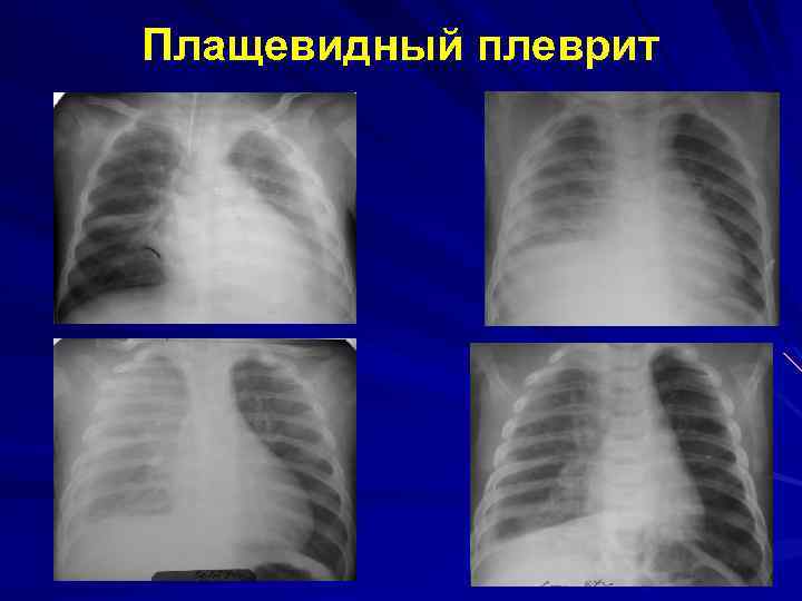 Плащевидный плеврит 