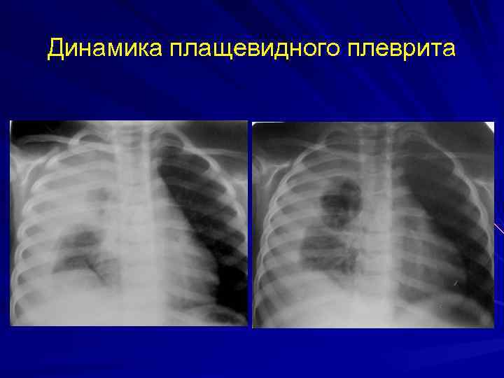 Динамика плащевидного плеврита 