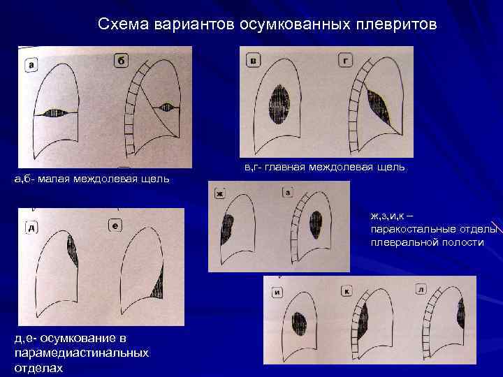 Схема вариантов осумкованных плевритов а, б- малая междолевая щель в, г- главная междолевая щель