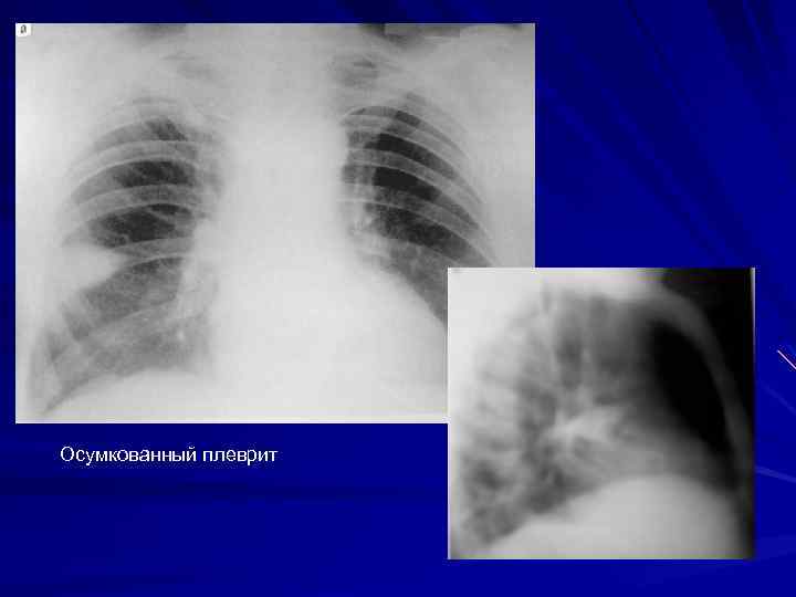 Осумкованный плеврит 