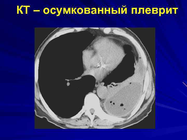КТ – осумкованный плеврит 
