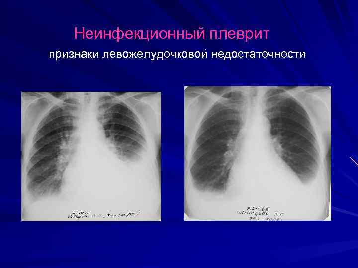 Неинфекционный плеврит признаки левожелудочковой недостаточности 