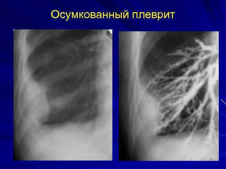 Осумкованный плеврит 
