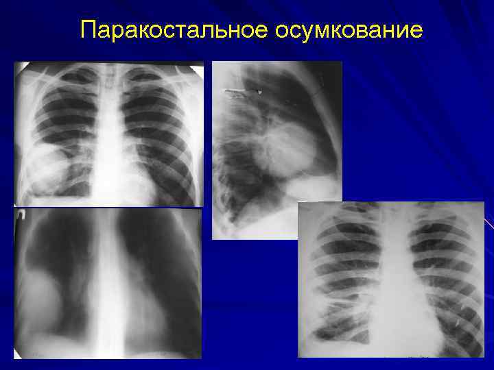 Паракостальное осумкование 