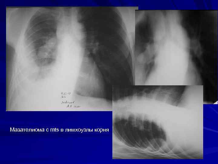 Мазателиома с mts в лимхоузлы корня 