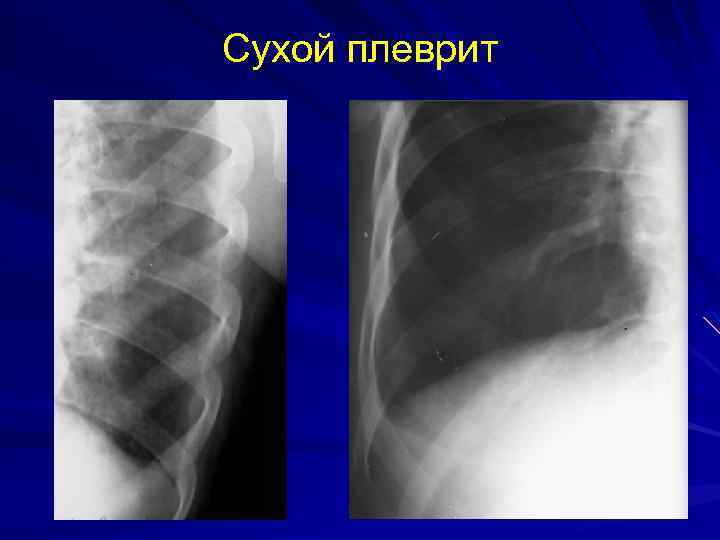 Сухой плеврит 