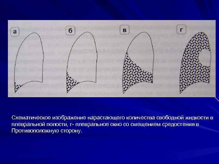 Схематическое изображение нарастающего количества свободной жидкости в плевральной полости, г- плевральное окно со смещением