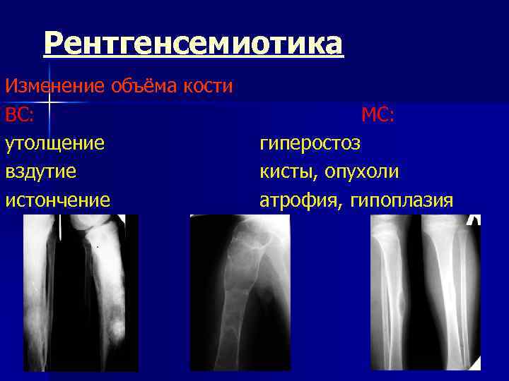 Рентгенсемиотика Изменение объёма кости ВС: утолщение вздутие истончение МС: гиперостоз кисты, опухоли атрофия, гипоплазия