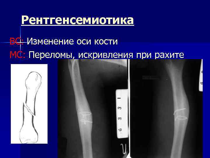 Рентгенсемиотика ВС: Изменение оси кости МС: Переломы, искривления при рахите 