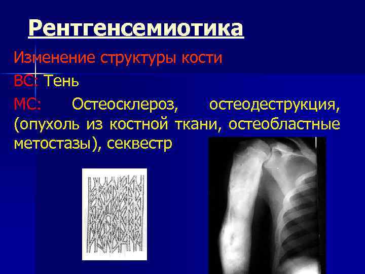 Рентгенсемиотика Изменение структуры кости ВС: Тень МС: Остеосклероз, остеодеструкция, (опухоль из костной ткани, остеобластные