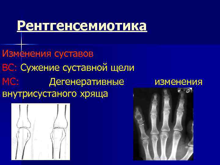 Рентгенсемиотика Изменения суставов ВС: Сужение суставной щели МС: Дегенеративные внутрисустаного хряща изменения 