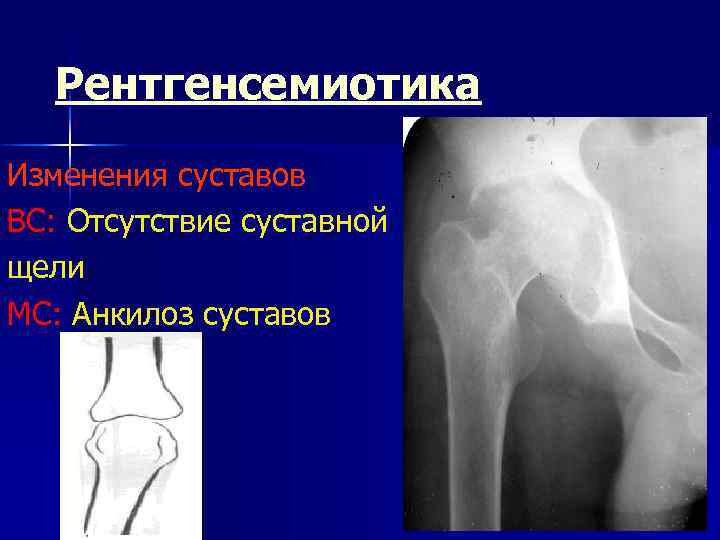 Рентгенсемиотика Изменения суставов ВС: Отсутствие суставной щели МС: Анкилоз суставов 