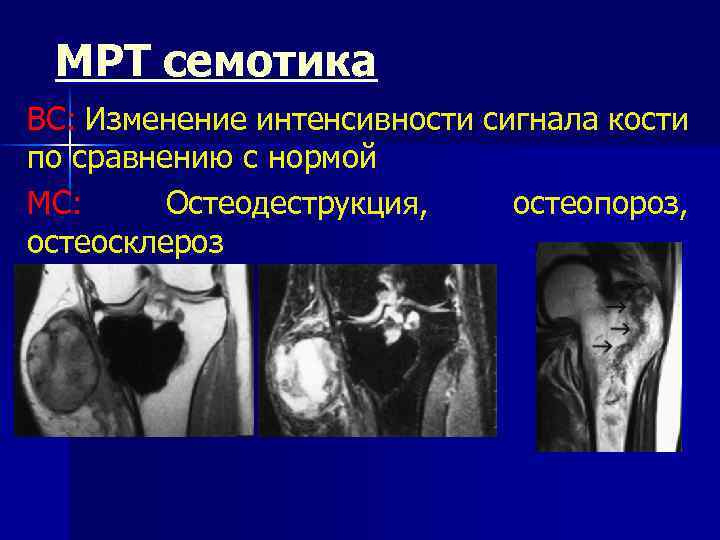 МРТ семотика ВС: Изменение интенсивности сигнала кости по сравнению с нормой МС: Остеодеструкция, остеопороз,