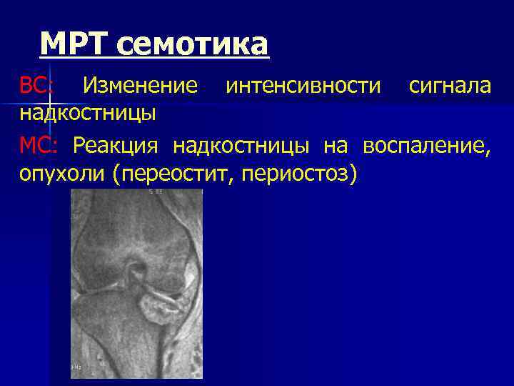 МРТ семотика ВС: Изменение интенсивности сигнала надкостницы МС: Реакция надкостницы на воспаление, опухоли (переостит,