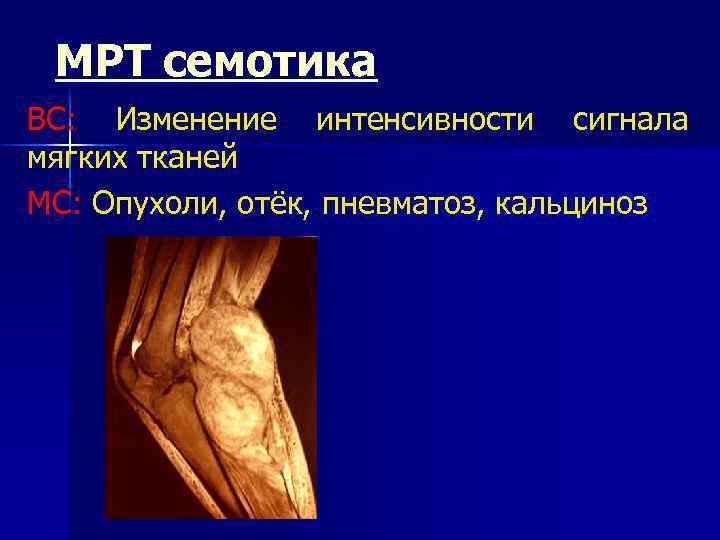 МРТ семотика ВС: Изменение интенсивности сигнала мягких тканей МС: Опухоли, отёк, пневматоз, кальциноз 