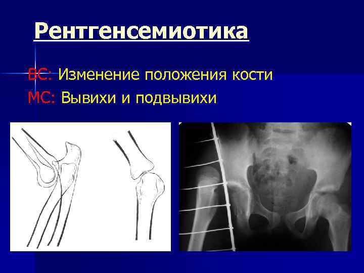Рентгенсемиотика ВС: Изменение положения кости МС: Вывихи и подвывихи 