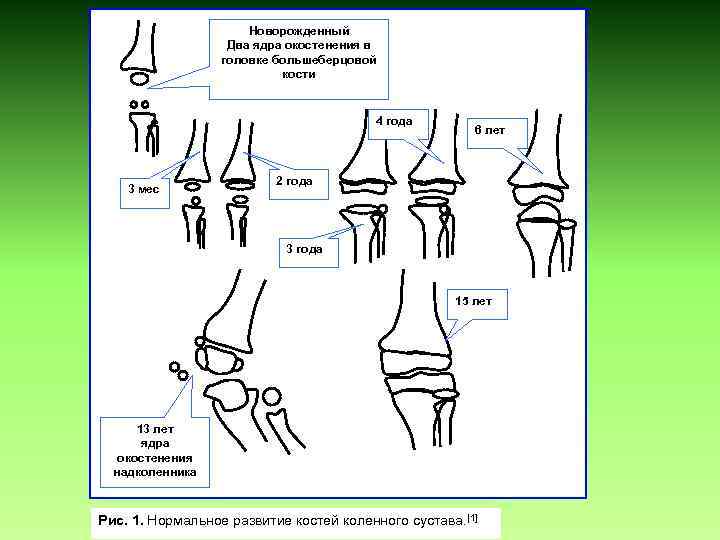 Новорожденный Два ядра окостенения в головке большеберцовой кости 4 года 3 мес 6 лет