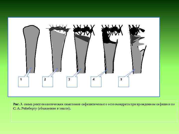 1 2 3 4 5 Рис. 3. схема рентгенологических симптомов сифилитического остеохондрита при врожденном