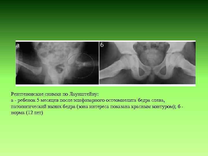 Рентгеновские снимки по Лаунштейну: а - ребенок 5 месяцев после эпифизарного остеомиелита бедра слева,