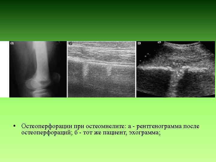 • Остеоперфорации при остеомиелите: а - рентгенограмма после остеоперфораций; б - тот же