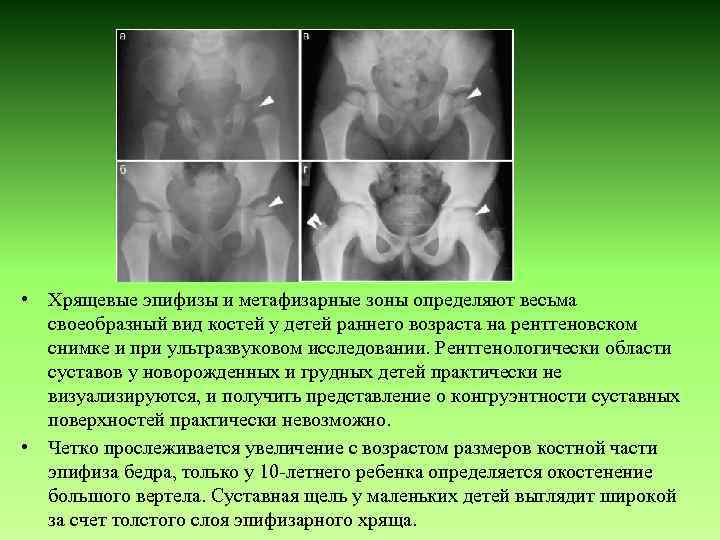  • Хрящевые эпифизы и метафизарные зоны определяют весьма своеобразный вид костей у детей