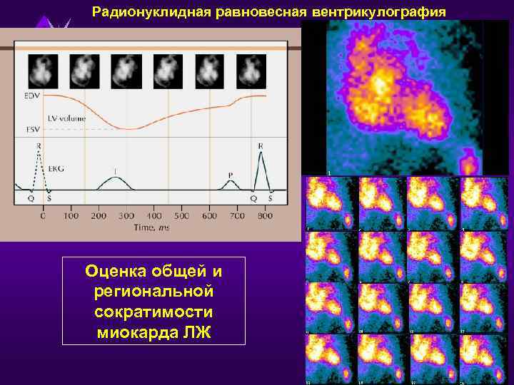 Радионуклидная равновесная вентрикулография Оценка общей и региональной сократимости миокарда ЛЖ 