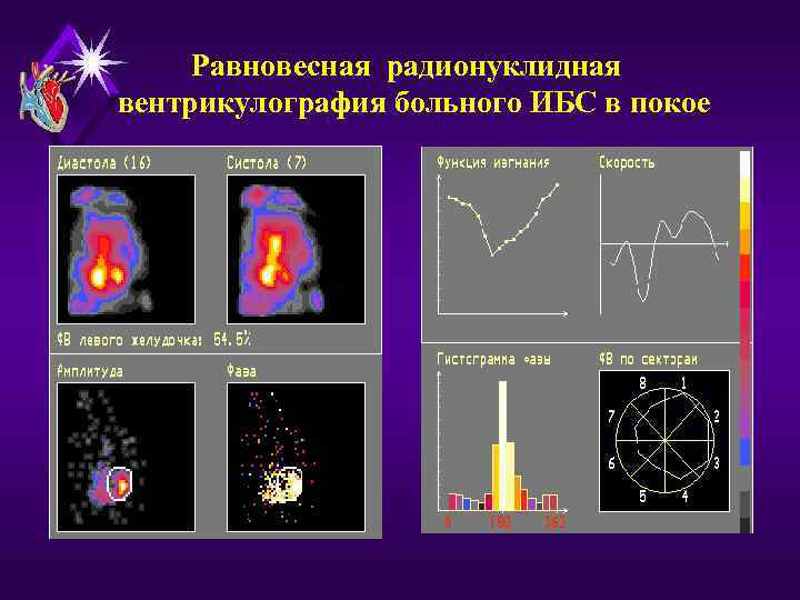 Равновесная радионуклидная вентрикулография больного ИБС в покое 