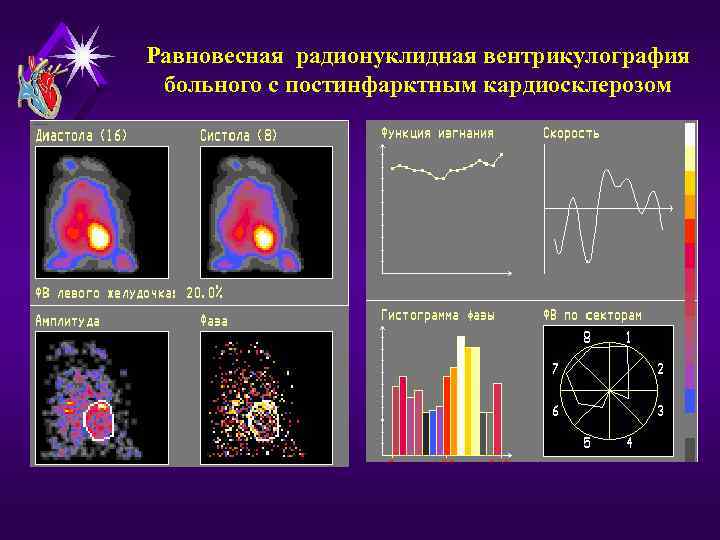 Равновесная радионуклидная вентрикулография больного с постинфарктным кардиосклерозом 