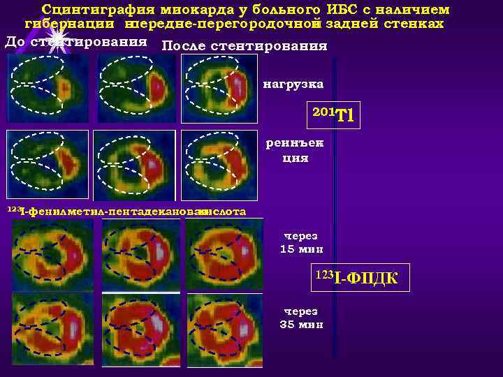 Сцинтиграфия миокарда у больного ИБС с наличием гибернации в передне-перегородочной задней стенках и До