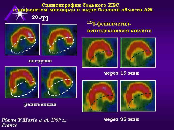 Сцинтиграфия больного ИБС с инфарктом миокарда в задне-боковой области ЛЖ 201 Tl 123 I-фенилметил-