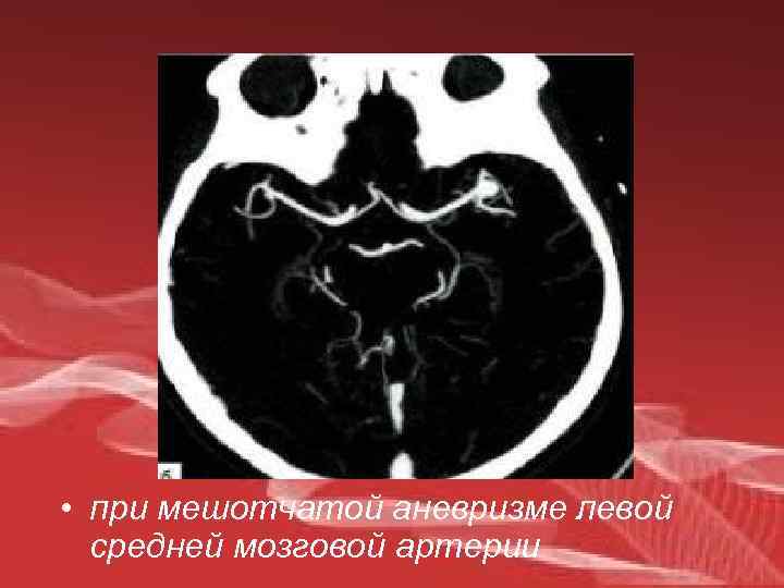  • при мешотчатой аневризме левой средней мозговой артерии 