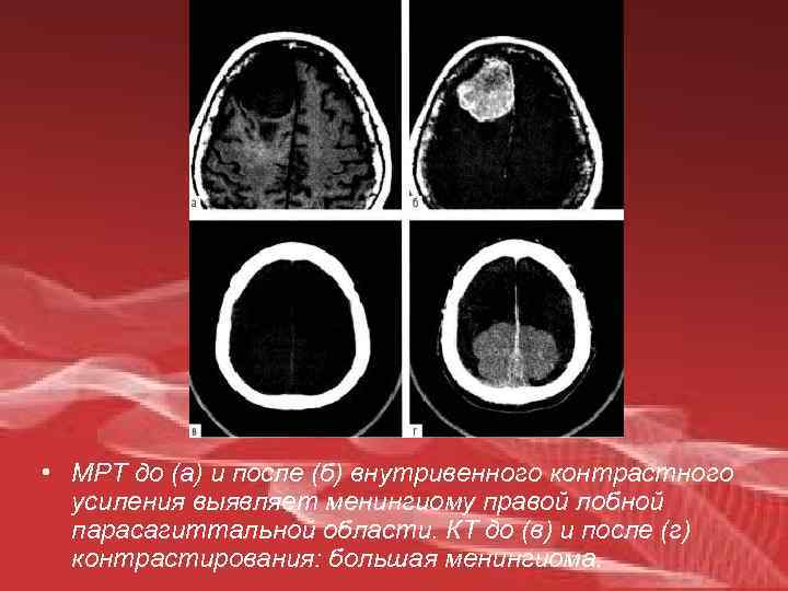  • МРТ до (а) и после (б) внутривенного контрастного усиления выявляет менингиому правой