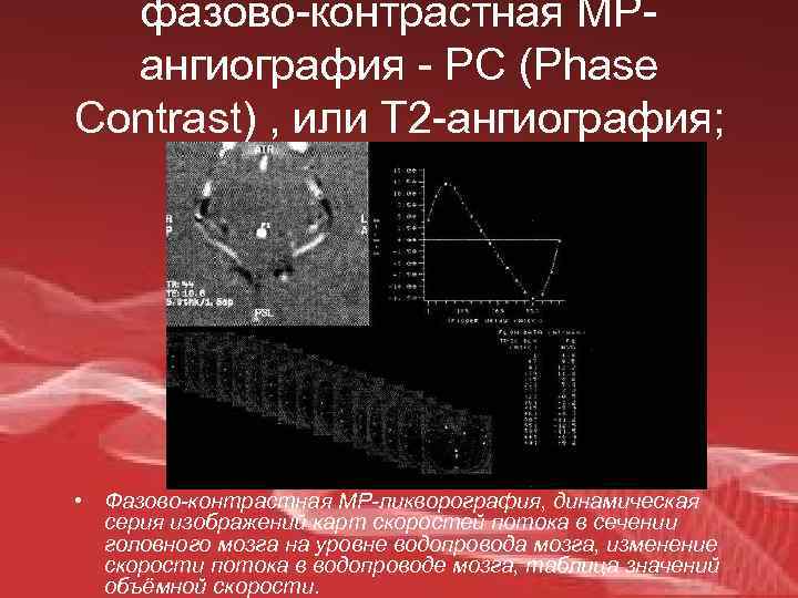 фазово-контрастная МРангиография - РС (Phase Contrast) , или Т 2 -ангиография; • Фазово-контрастная МР-ликворография,