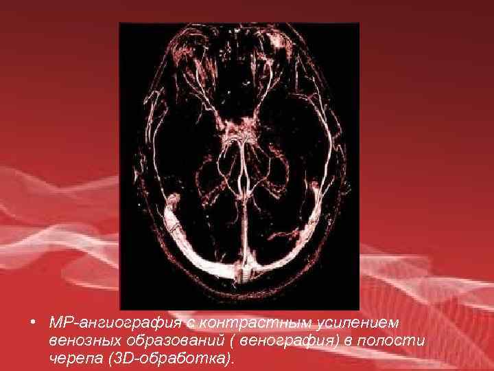  • МР-ангиография с контрастным усилением венозных образований ( венография) в полости черепа (3