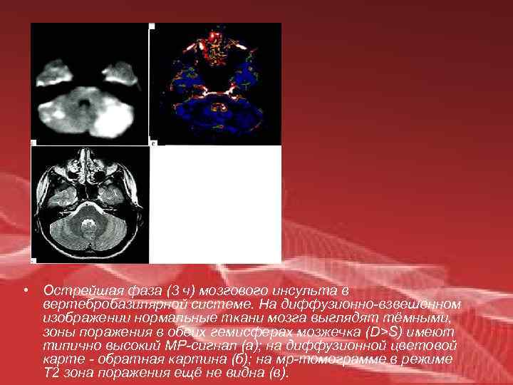  • Острейшая фаза (3 ч) мозгового инсульта в вертебробазилярной системе. На диффузионно-взвешенном изображении