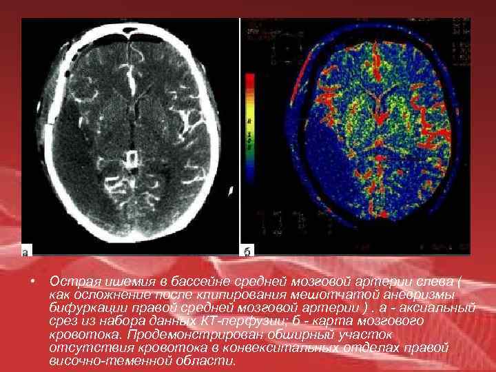  • Острая ишемия в бассейне средней мозговой артерии слева ( как осложнение после