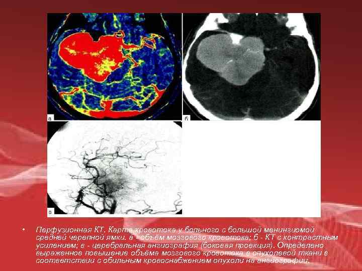  • Перфузионная КТ. Карта кровотока у больного с большой менингиомой средней черепной ямки.