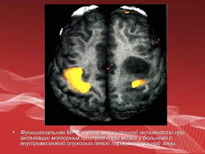  • Функциональная МРТ: карта нейрональной активности при активации моторных центров коры мозга у