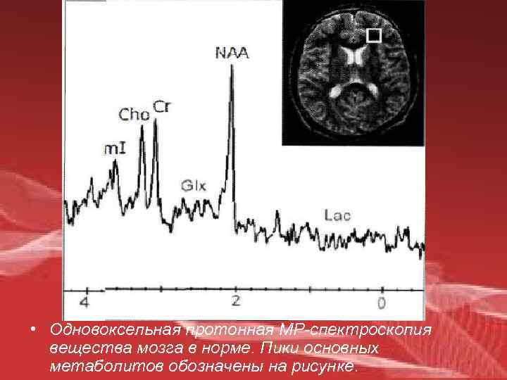  • Одновоксельная протонная МР-спектроскопия вещества мозга в норме. Пики основных метаболитов обозначены на