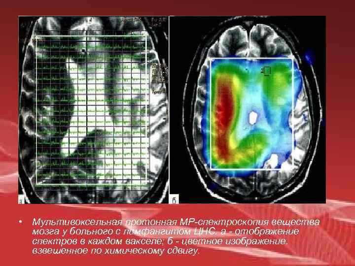  • Мультивоксельная протонная МР-спектроскопия вещества мозга у больного с лимфангитом ЦНС. а -