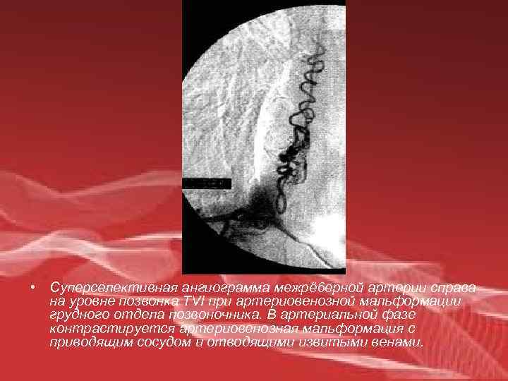  • Суперселективная ангиограмма межрё 6 ерной артерии справа на уровне позвонка TVI при
